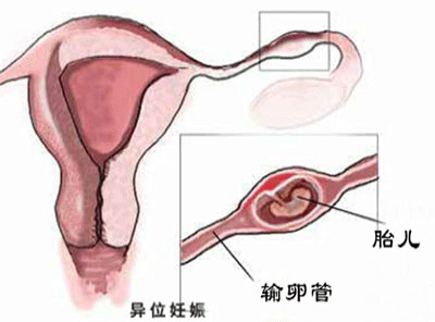 《宫外孕后怎么备孕呢》