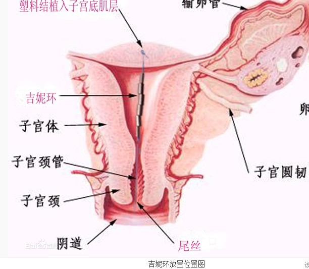 《吉妮环取环要注意哪些事项》