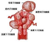 《子宫肌瘤——切还是不切》