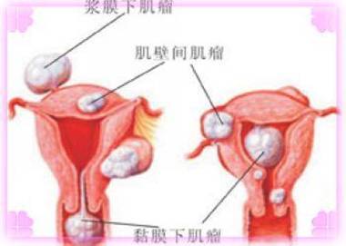 《粘膜下子宫肌瘤》