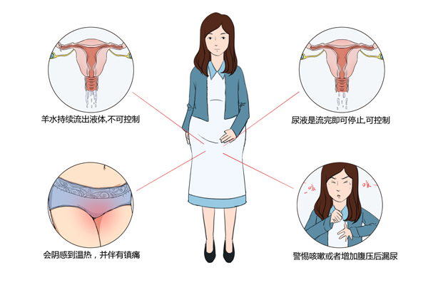 《怎样判断是漏羊水还是尿》